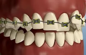 Norwalk Braces: Orthodontic Treatment for an Unstrained Smile