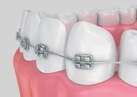 Norwalk Orthodontics: Modern Solutions & Create New Smiles for Any Age?