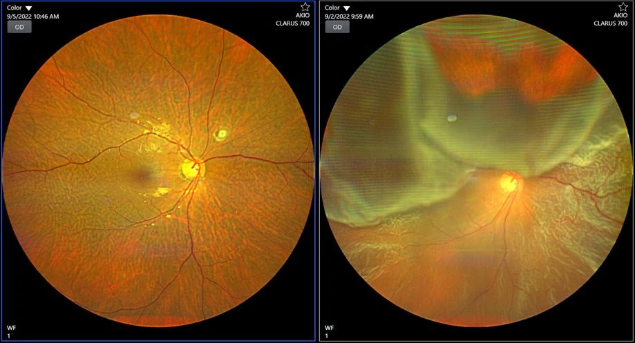 Choosing the Right Retina Specialist in Delhi for Better Eye Health