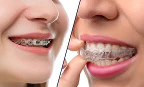 Which Orthodontist in East Cobb Is Best for Invisalign and Braces?