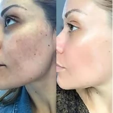 Cosmelan Pigmentation Treatment in Altrincham for Acne Scars and Dark Spots