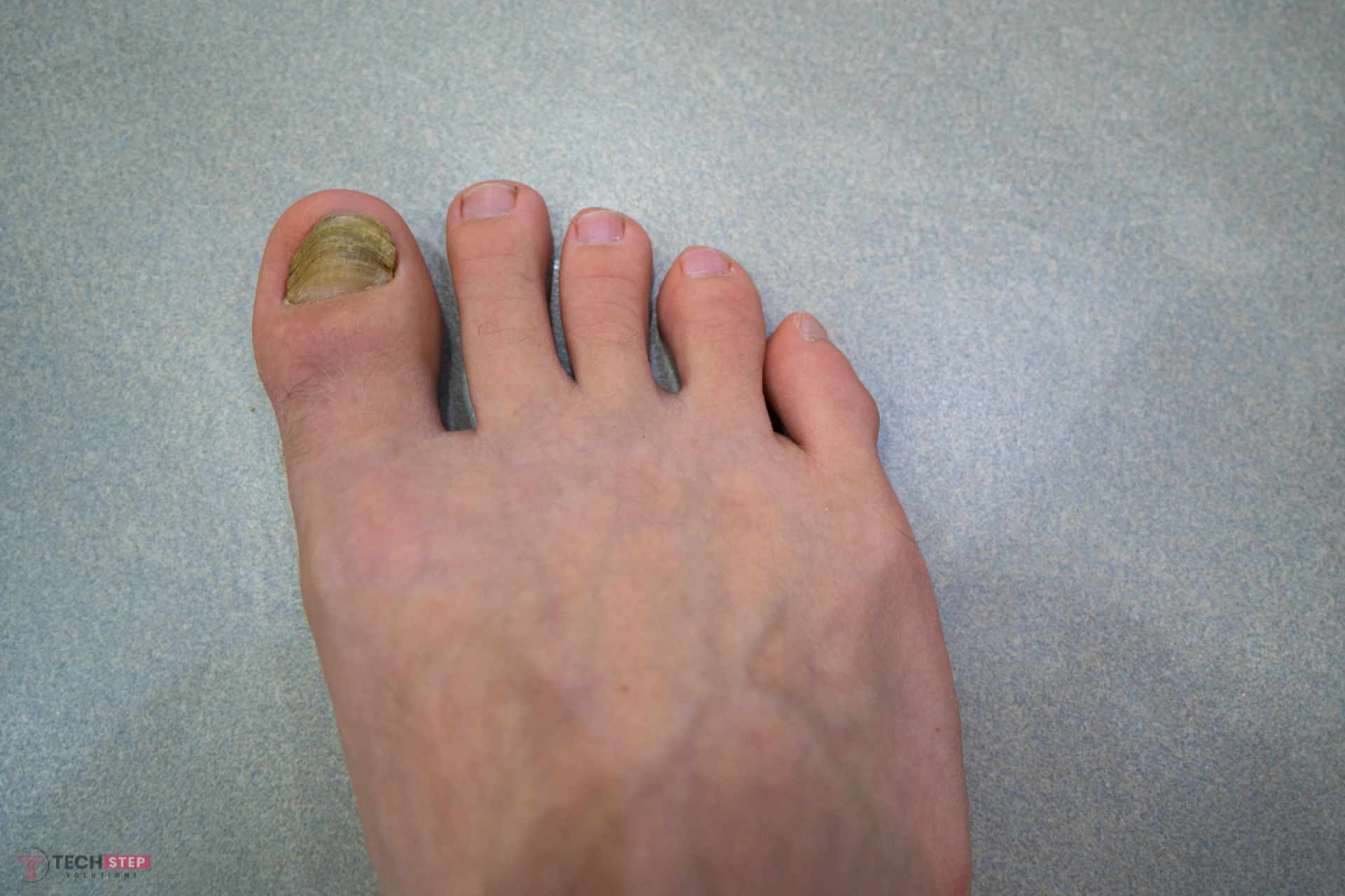 How To Know If Toenail Fungus Is Dying: Easy Signs To Watch