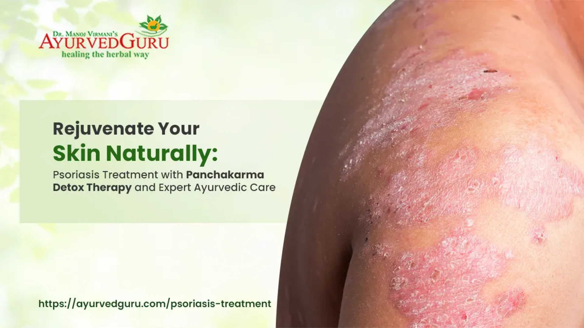 Rejuvenate Your Skin Naturally: Psoriasis Treatment with Panchakarma Detox Therapy and Expert Ayurvedic Care