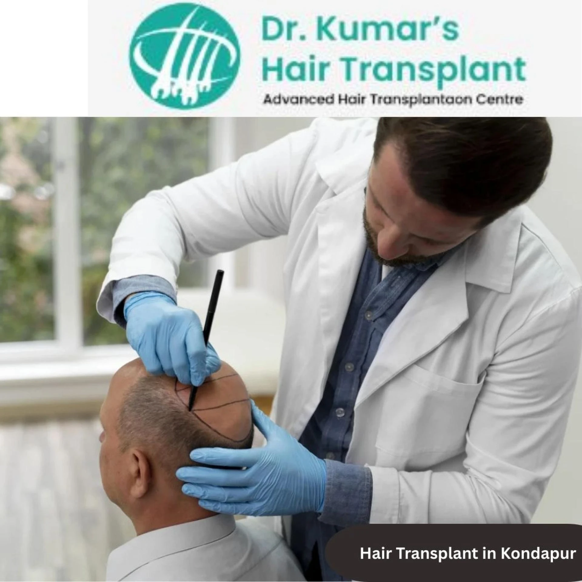 Is DHI Hair Transplant Permanent? What You Should Know