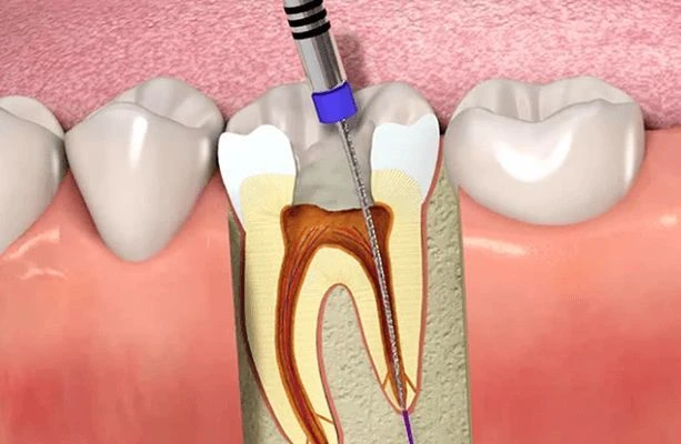 Root Canal Treatment - A Perfect Guide for Newbies
