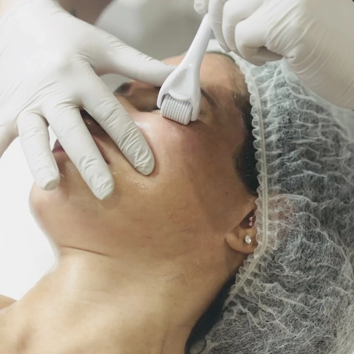 A Professional’s Guide to Choosing the Right Microneedling Kit for Client Treatments
