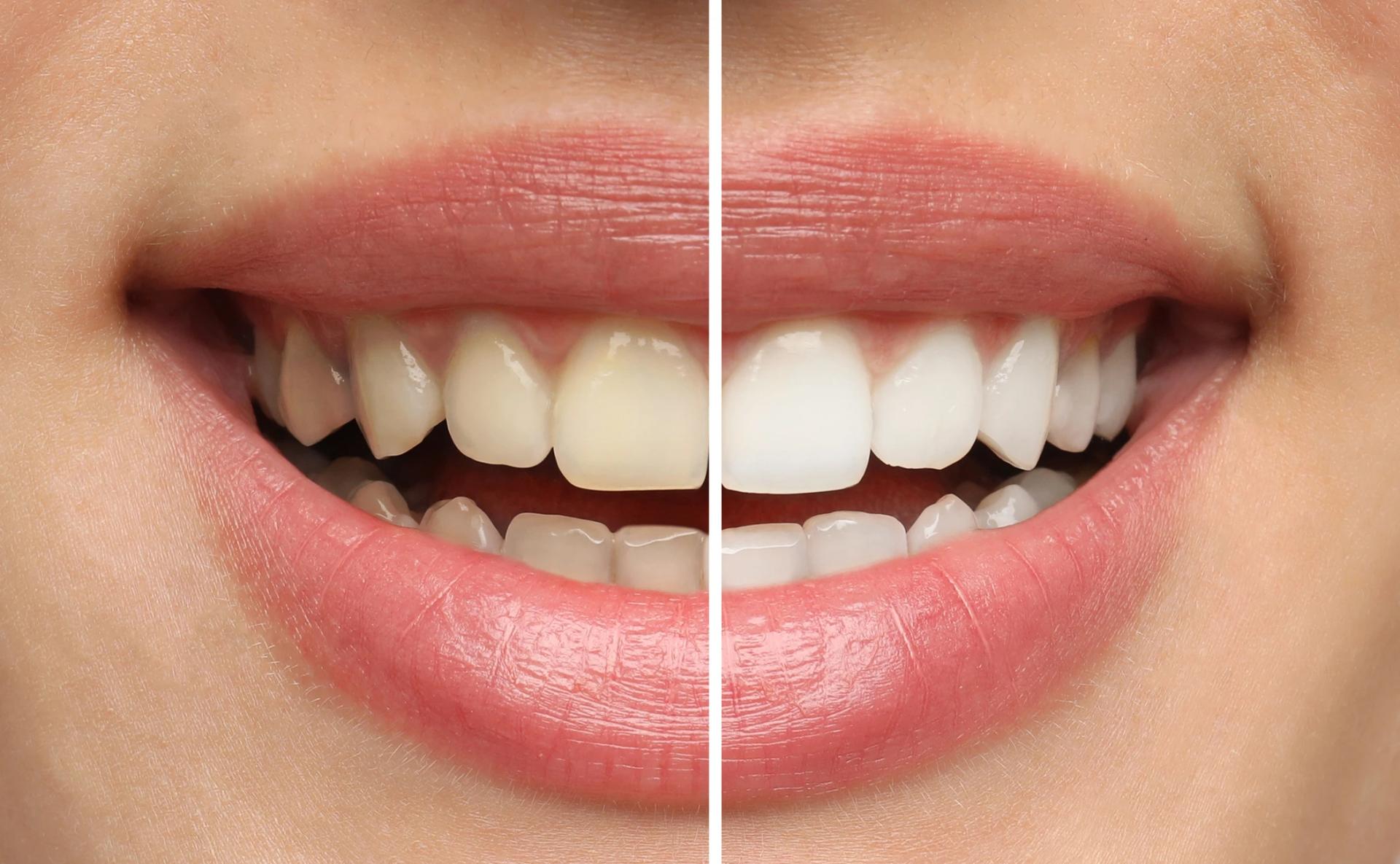 Teeth Whitening in Bowie MD for a Brighter, More Confident Smile