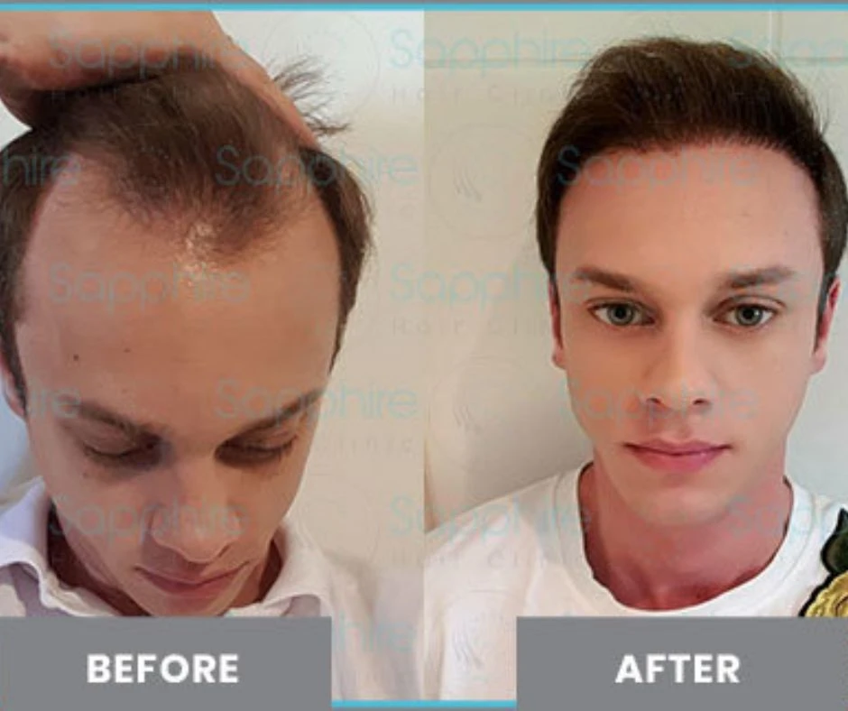 The Rise of Hair Transplant Istanbul in Medical Tourism: Why the World Is Flying to Turkey for Fuller Hair