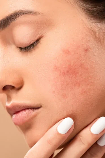 Best Skin Care Clinic In Gurgaon for Advanced Dermatology & Aesthetic Treatments | The Derma Clinic