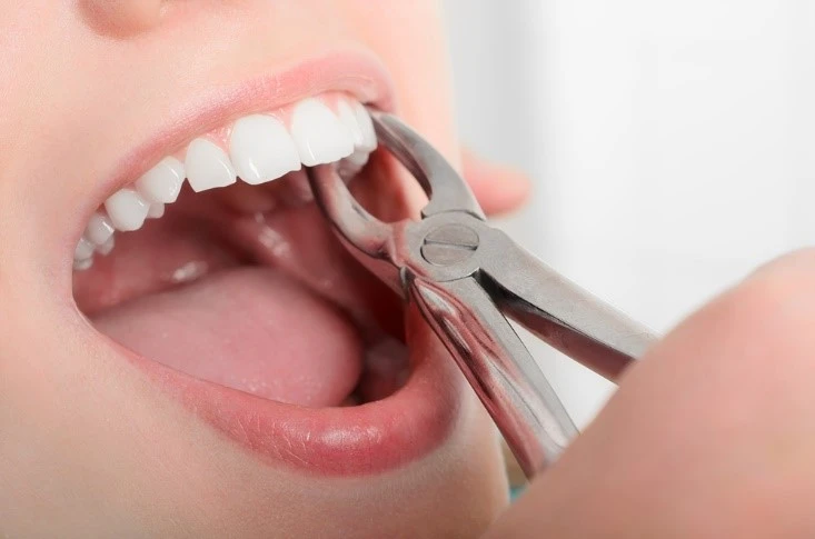 Tooth Extraction or Root Canal: Which Dental Treatment Is Right for You?