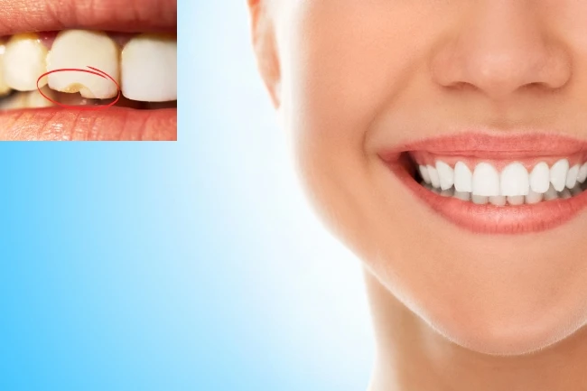 How Cavity Fillings Work: A Simple Guide for Patients