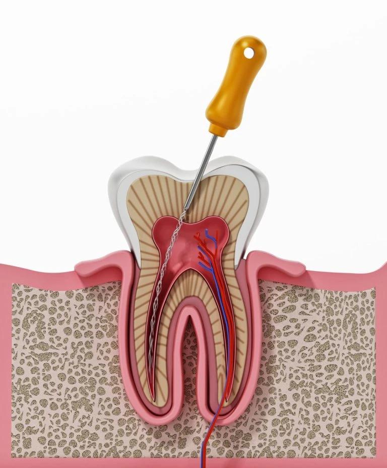How Root Canal Treatment Can Save Your Smile and Oral Health