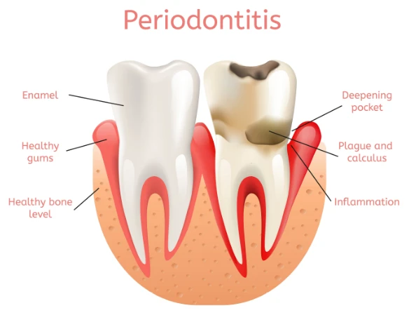 Which Tempe Periodontist Offers Advanced Gum Disease Treatment?