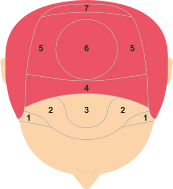 Why Do Hair Clinics Use the Norwood Scale Hair Loss to Guide Treatment?