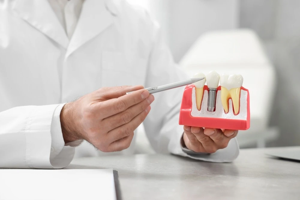 Why a Dental Implant Consultation Is Crucial Before Treatment?