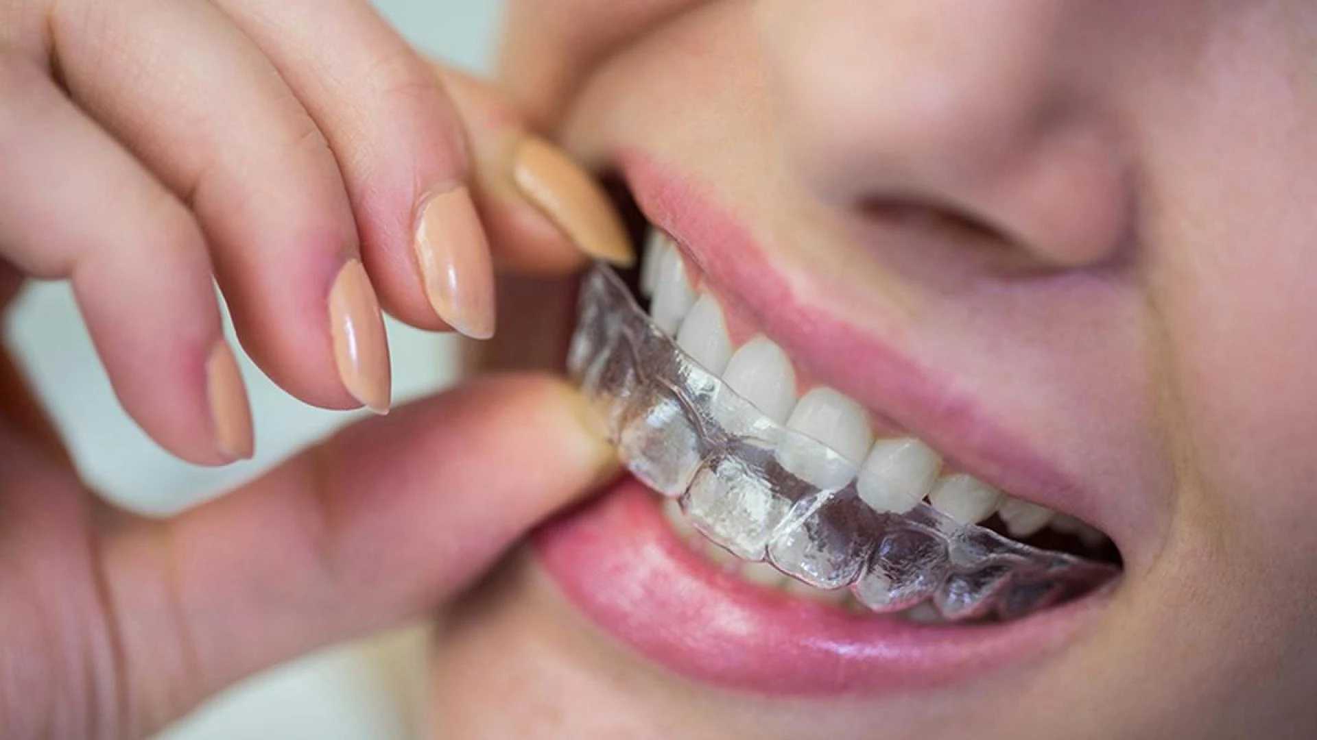 Why More Patients Are Choosing Aligners Treatment in Nashik