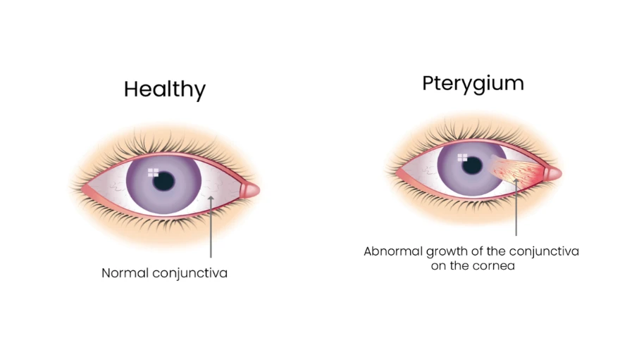 Ophthalmic Treatments in Brisbane: Managing Dry Eye Syndrome and Surgical Options