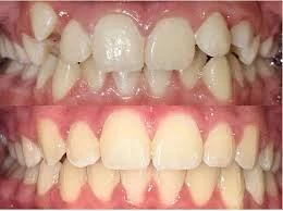 Tiny Teeth, Big Smiles: Preparing Your Toddler for Their First Dental Visit in League City