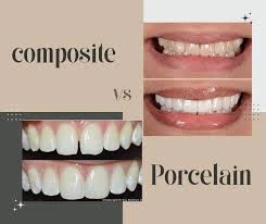 Where Can I Get Affordable Composite Veneers in Seattle?