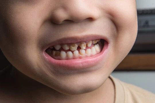 What Are the Signs of Cavities in Children and When Should You See a Dentist?