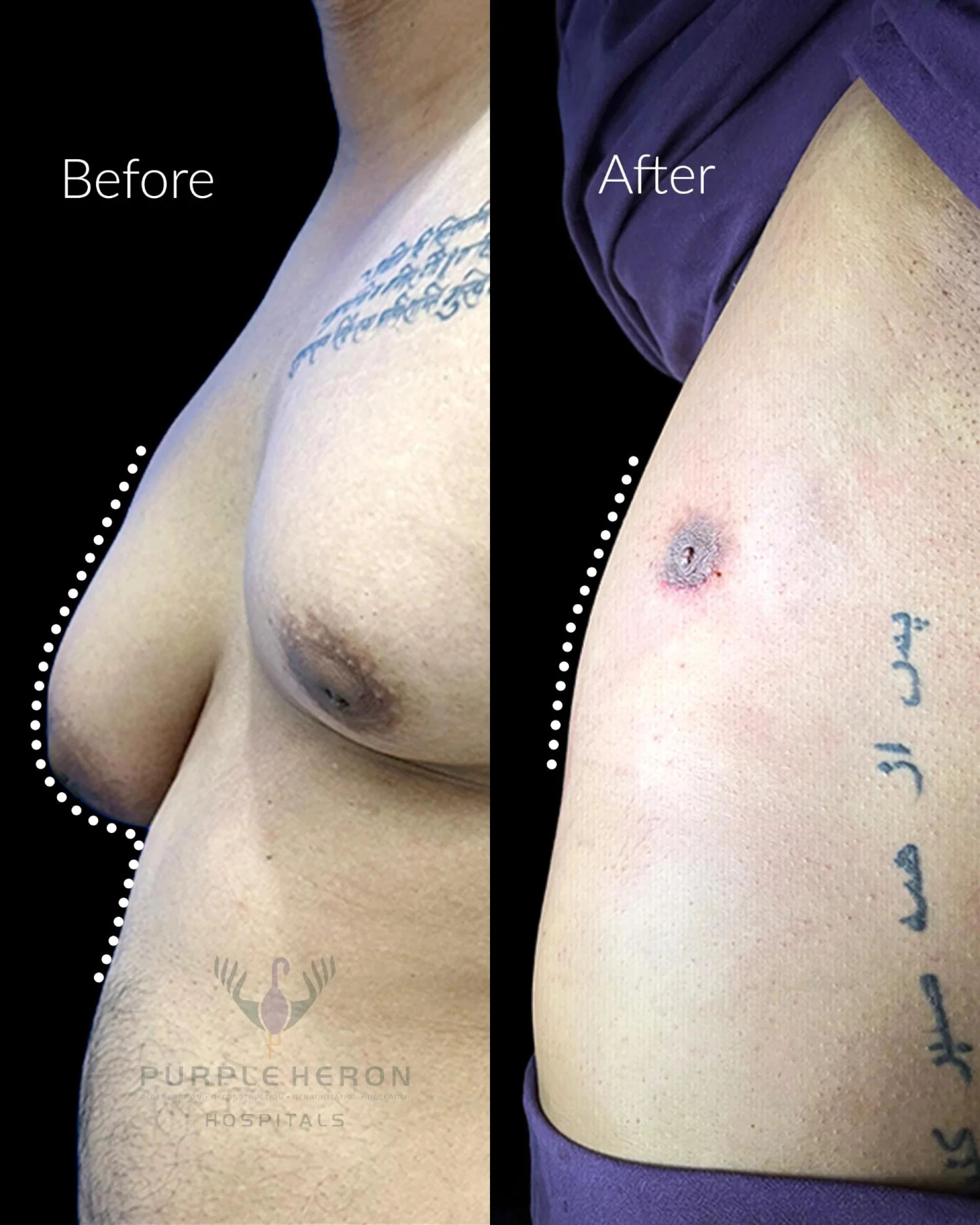 Gynaecomastia Treatment in Jaipur: Regain Confidence with Advanced Solutions