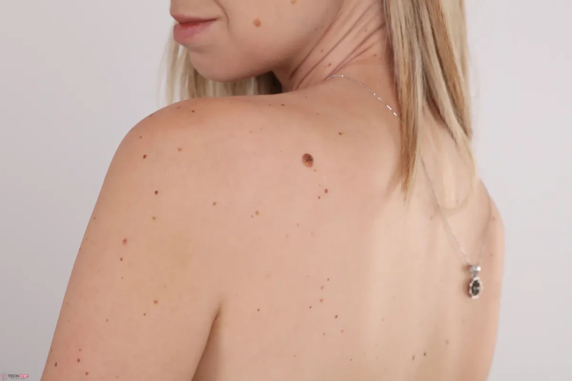 Are Skin Tags Contagious? Causes, Risks, and Expert Insights