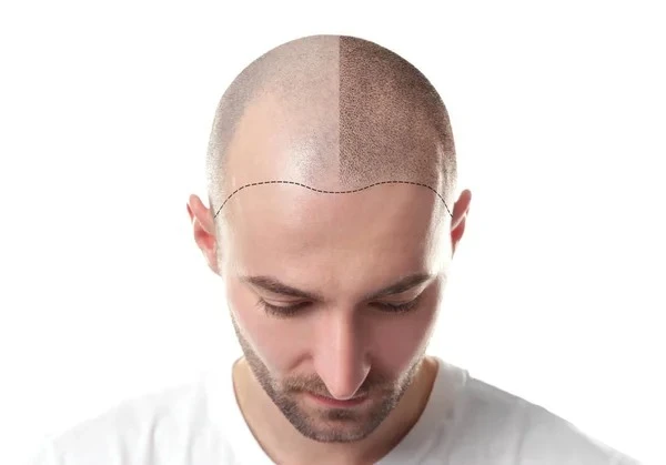 How much does 4000 grafts hair transplant cost in Pakistan?