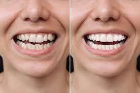 Which Cosmetic Dentist in Forest Hills Specializes in Veneers?