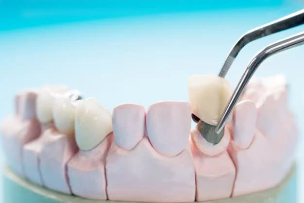 Best Clinics for Dental Crowns