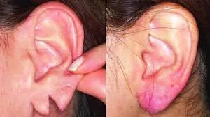 Best Earlobe Repair Centre in Gurgaon