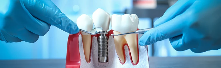 Dental Implant Consultation Explained: Your First Visit Guide