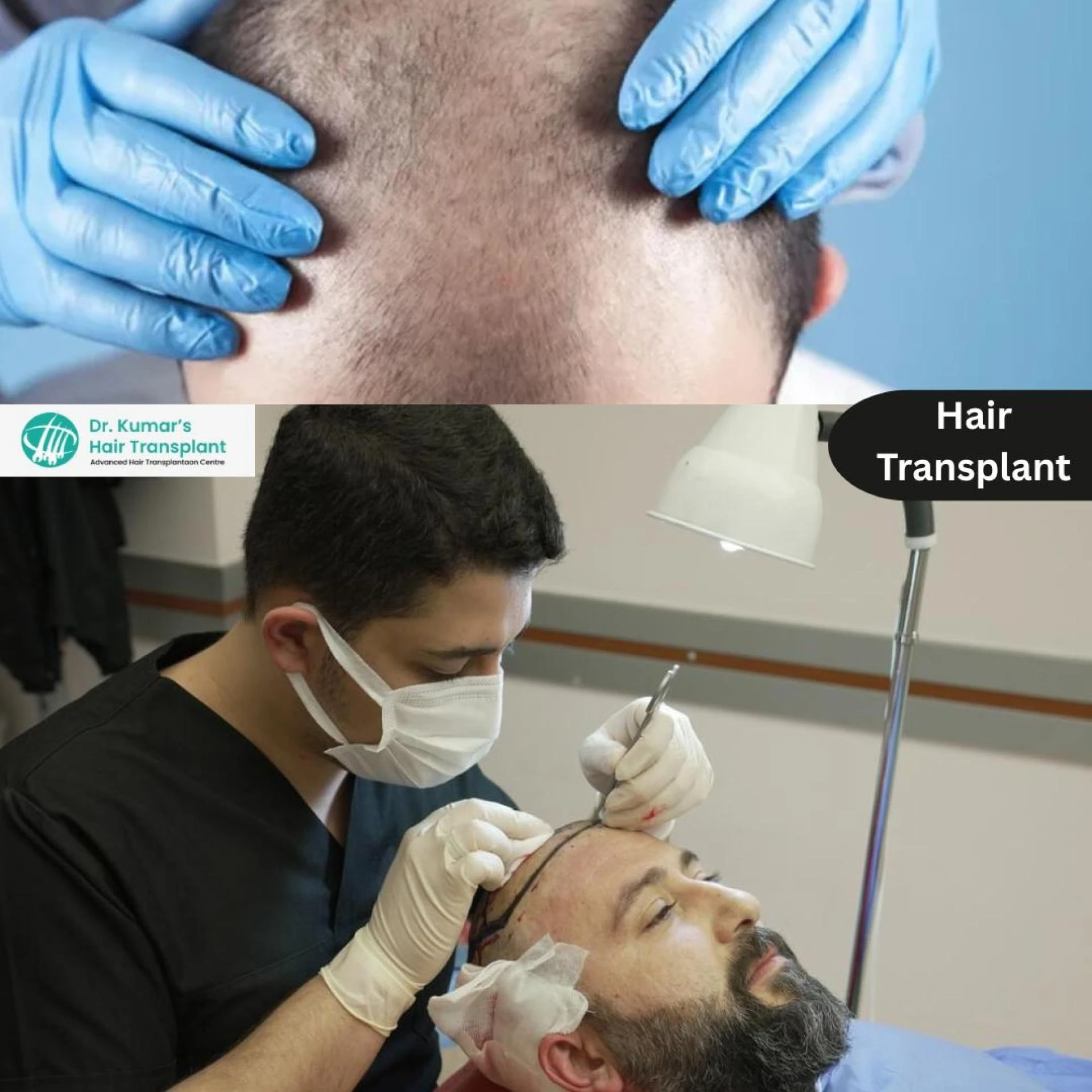 Hair Transplant Cost Breakup – What To Know & How To Plan?