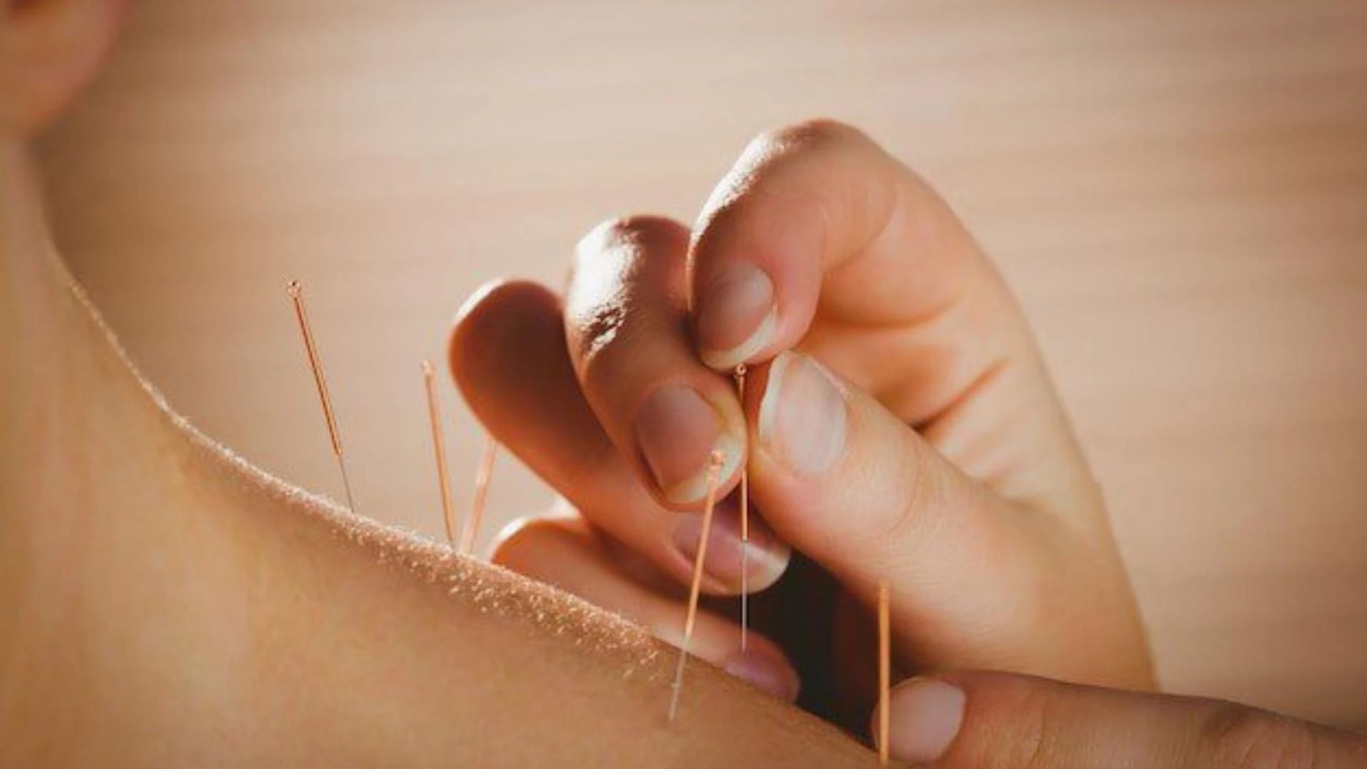 Have You Tried Dry Needle Therapy for Persistent Muscle Pain?