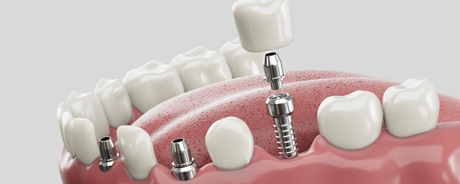 Same-Day Dental Implants: Are They Safe and Effective?
