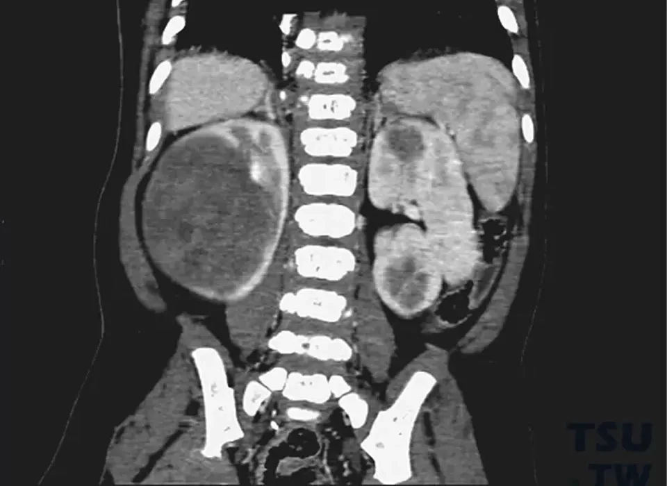 Guarding the Young Buds: A Century-long Battle to Conquer Childhood Nephroblastoma
