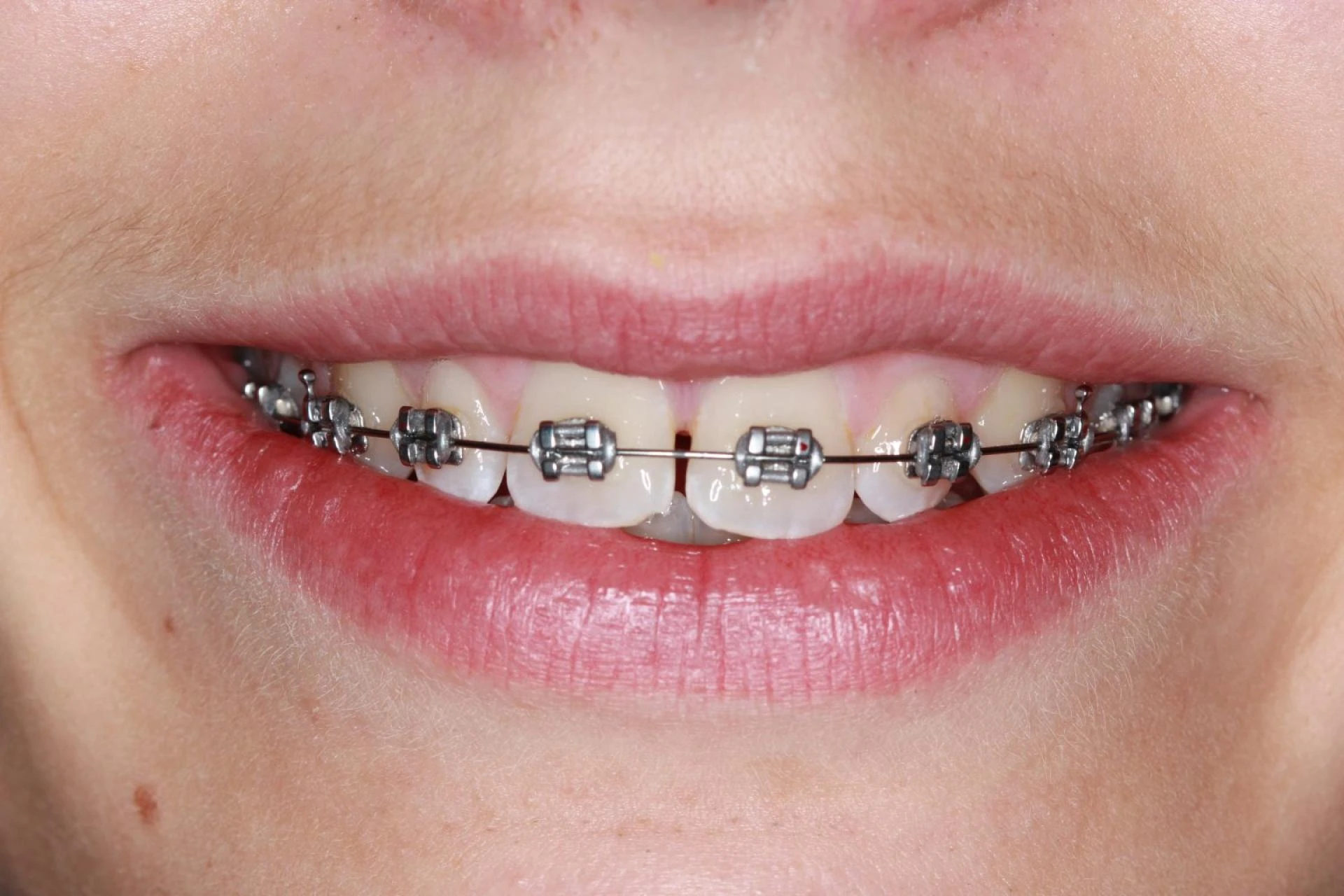 Braces Treatment Care Tips For Better Smile Results