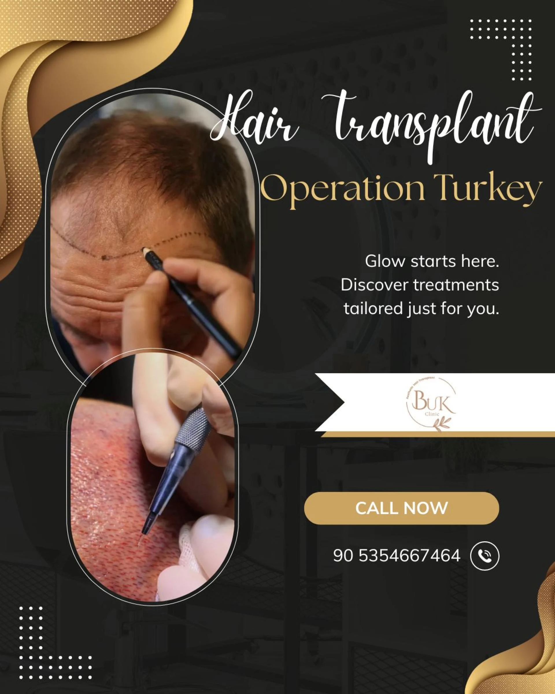 Hair Transplant Turkey: Complete Guide to Cost, Procedure, and Results