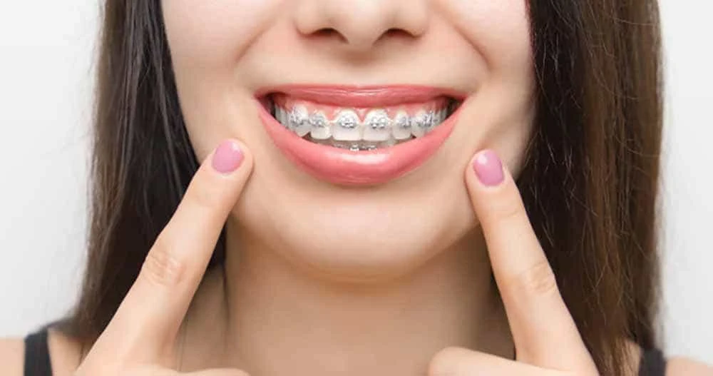 What to Eat and Avoid During Braces Treatment: A Complete Guide