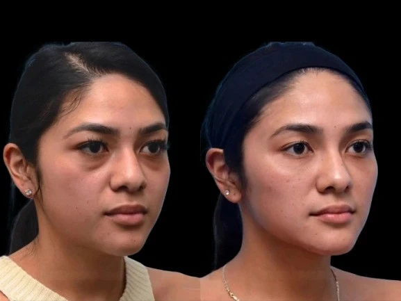 PRP Therapy for Dark Circles at the Best Aesthetic Clinics in Dubai