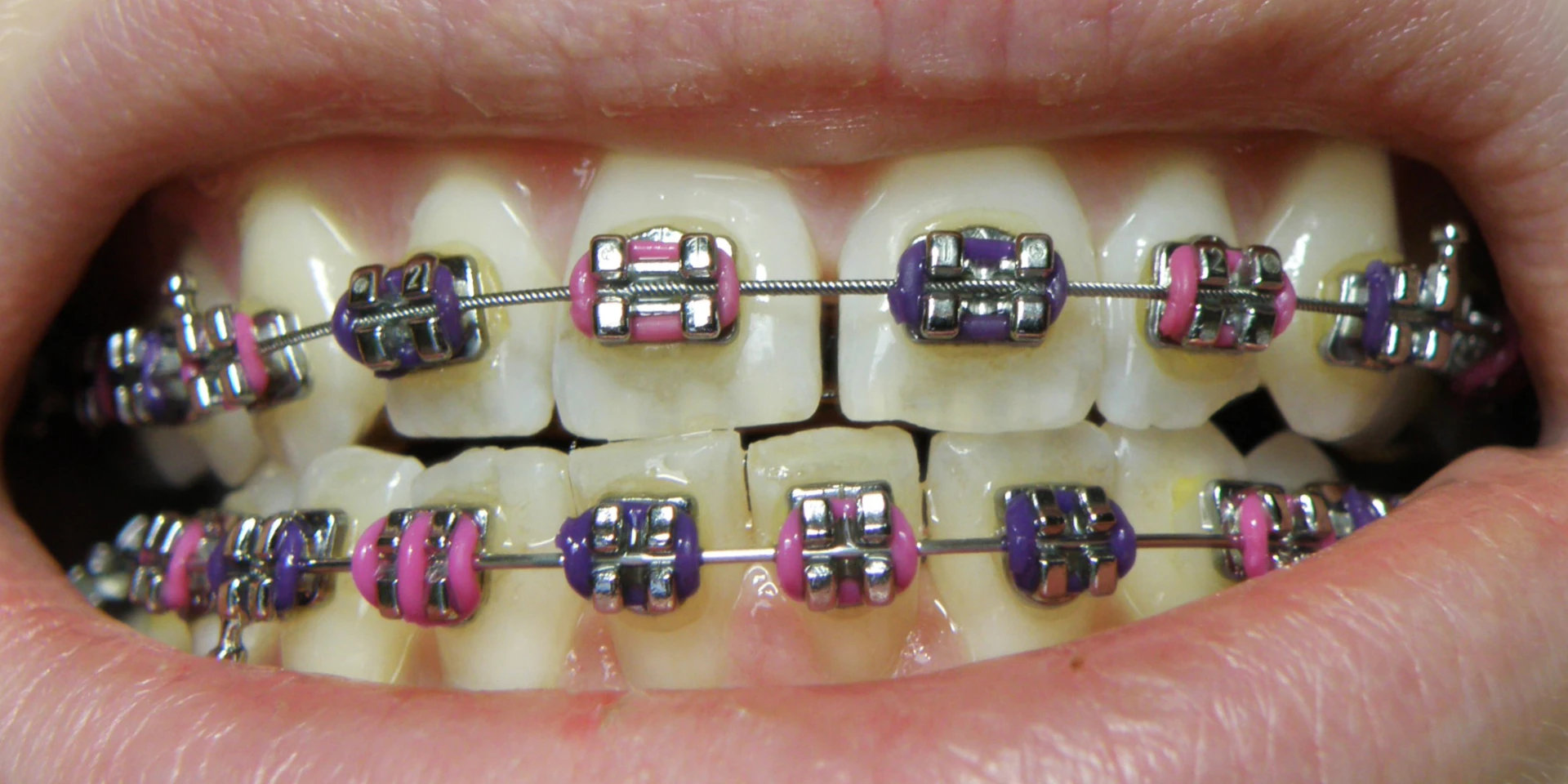 Traditional Braces Ventura CA: What You Need to Know