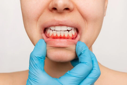 Understanding Gum Disease: What It Is And Why It Happens