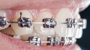 Orthodontics: Benefits, Types & Treatment Guide