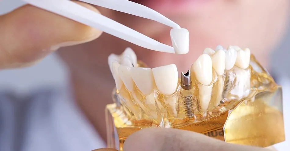 Personalized Dental Implant Solutions for a Healthy Smile in London