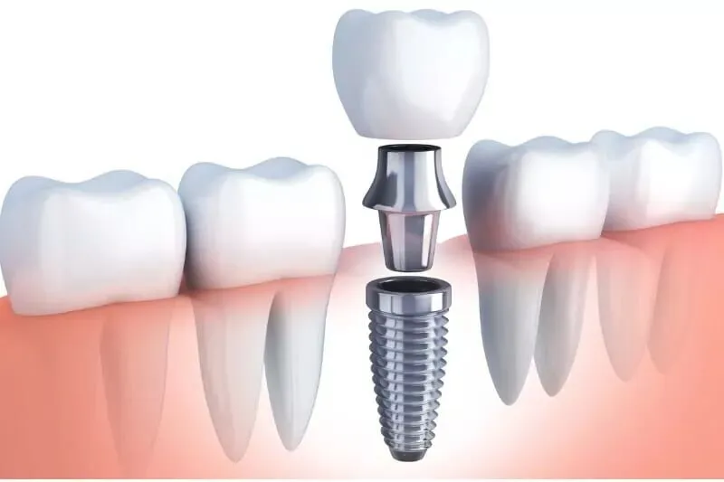 Maintaining Jawbone Health with Modern Dental Implants in Ontario