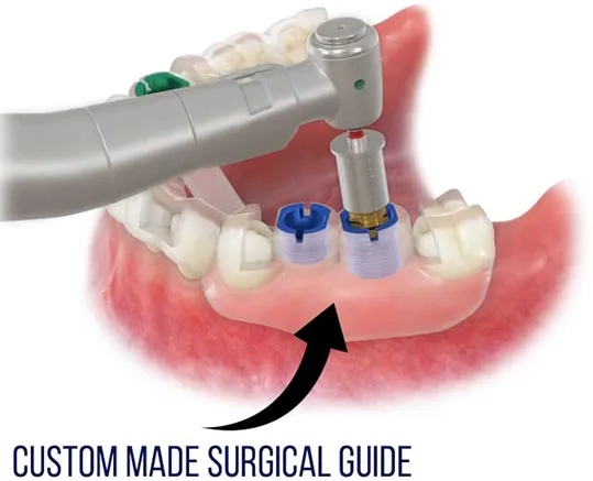 Average Cost Of Dental Implants