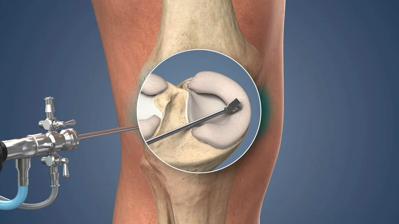 Best Arthroscopy Surgery Delhi: Advanced Keyhole Treatment for Joint Pain