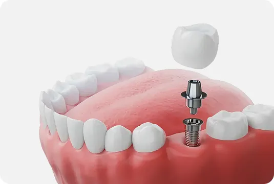 Understanding Dental Implant Cost Dubai: Affordable Solutions for a Confident Smile