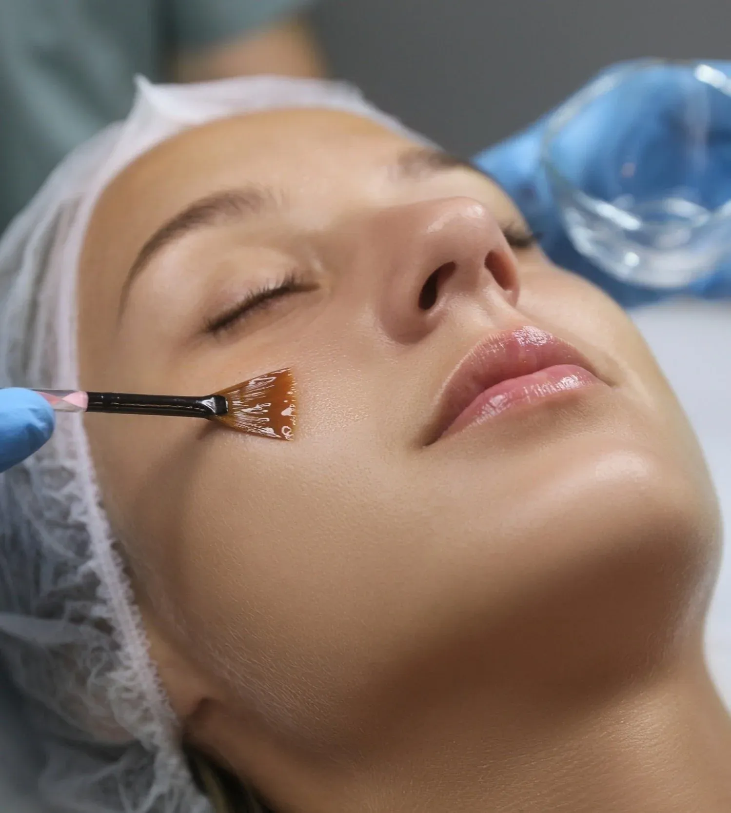 Chemical Peel Queens: A Complete Guide to Clearer, Smoother, Healthier Skin