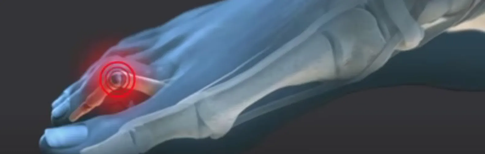 Hammertoe Surgery Cost: 7 Factors That Impact Your Final Bill