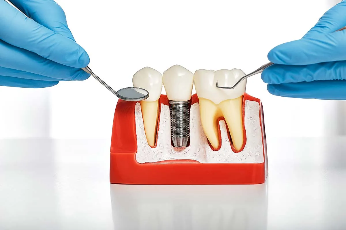 The Permanent Fix for Missing Teeth - Dental Implants in Nizamabad